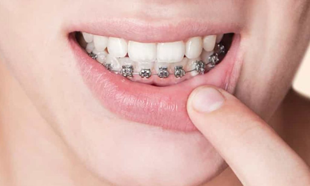 ارتودنسی فک پایین