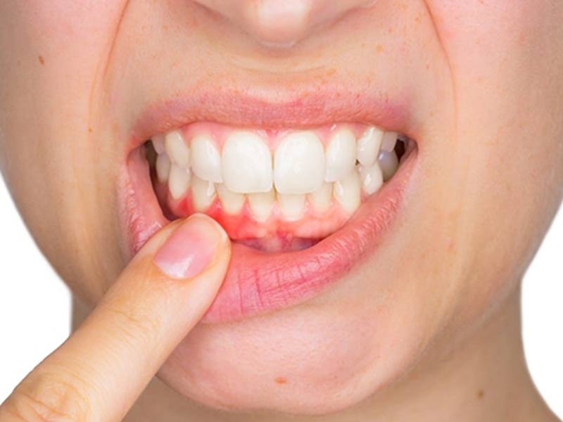 تحلیل لثه چیست؟