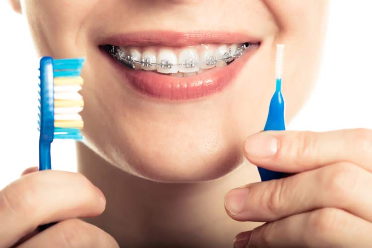 تمیز کردن بریس ارتودنسی