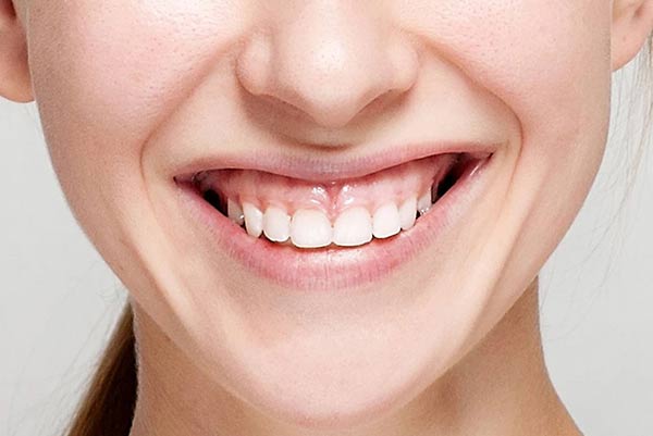 روش های درمان لبخند لثه ای