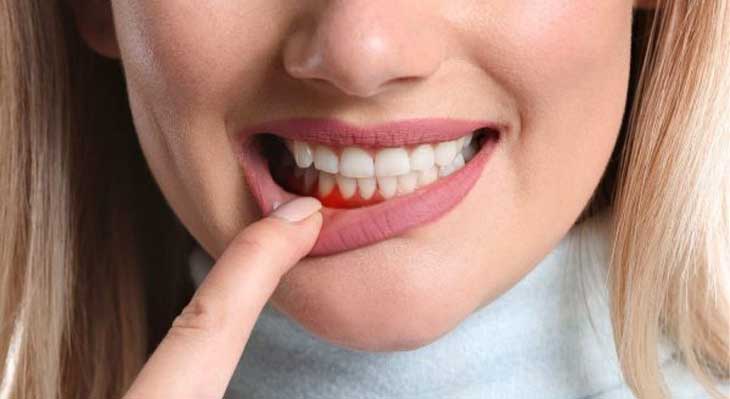 بیماری پریودنتال لثه چیست؟