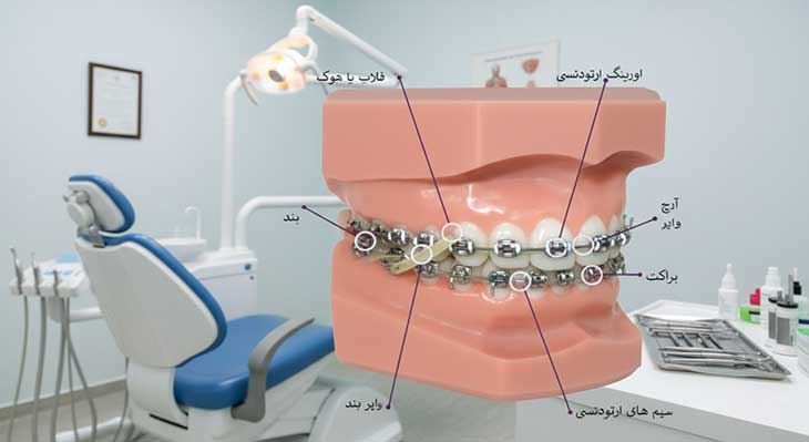 معرفی انواع اجزای ارتودنسی