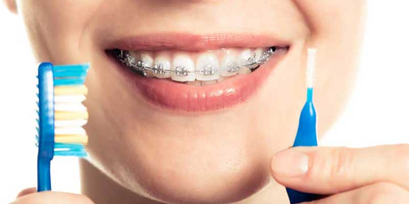 مراقبت از بریس ارتودنسی