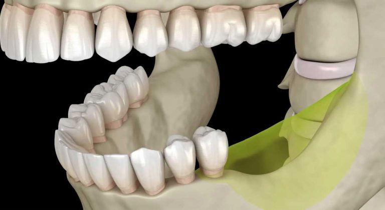 تحلیل استخوان فک