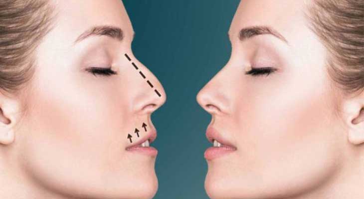 اول ارتودنسی انجام دهیم یا عمل بینی؟
