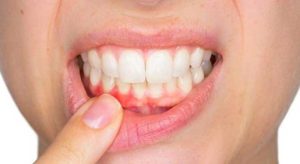 تحلیل لثه چیست؟