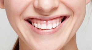 روش های درمان لبخند لثه ای
