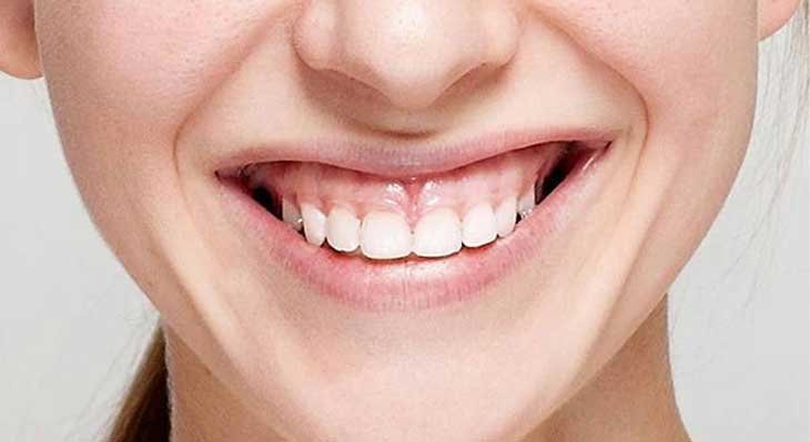 روش های درمان لبخند لثه ای