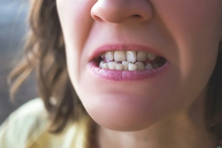 چگونه دندان های کج را بدون بریس صاف کنیم؟