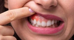 روش های درمان تحلیل لثه