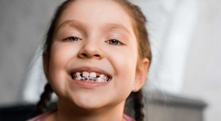 کجی دندان با زبان زدن به لثه و دندان