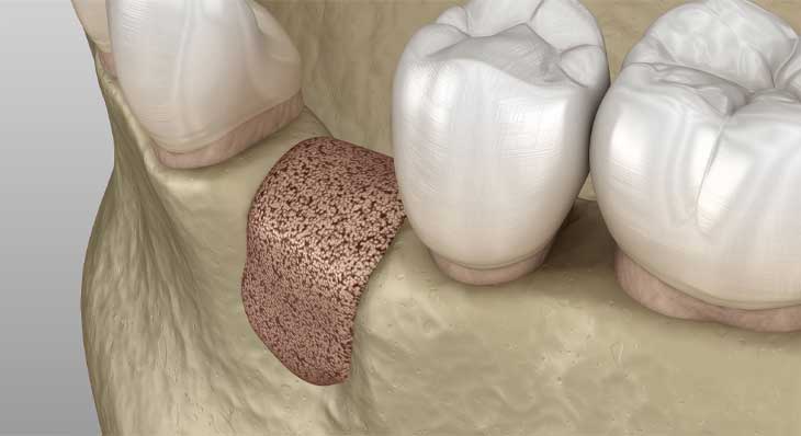 تحلیل استخوان فک