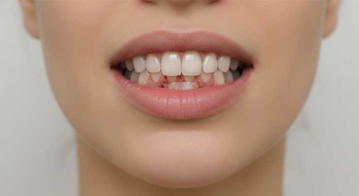 روش های درمان تحلیل لثه