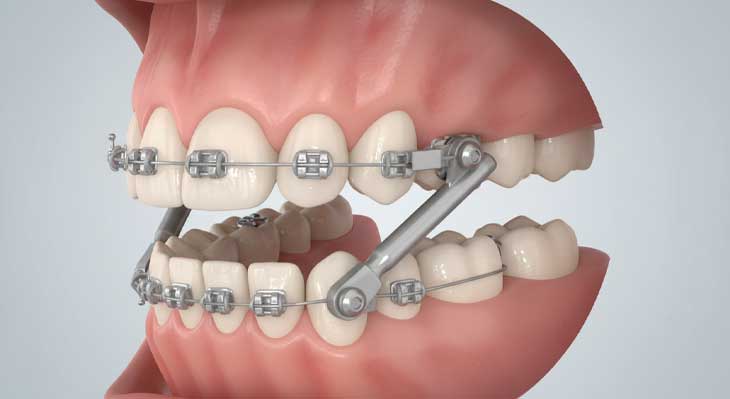 ارتودنسی کاموفلاژ چیست؟