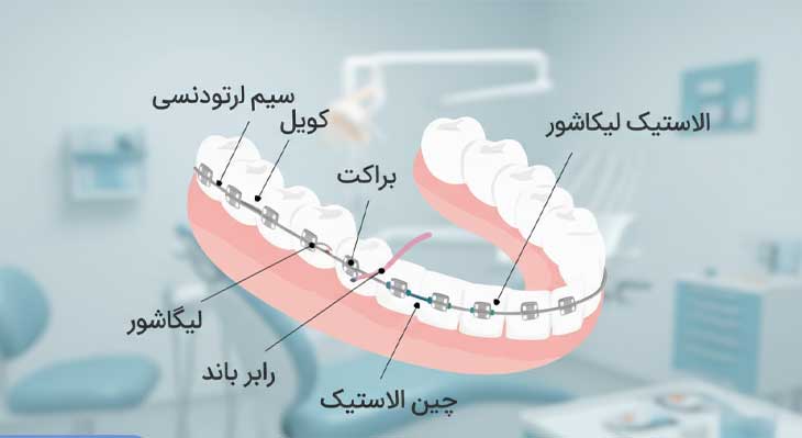 معرفی انواع اجزای ارتودنسی