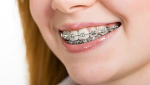 ارتودنسی فلزی بهتر است یا نامرئی؟