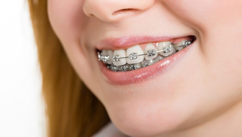 ارتودنسی فلزی بهتر است یا نامرئی؟