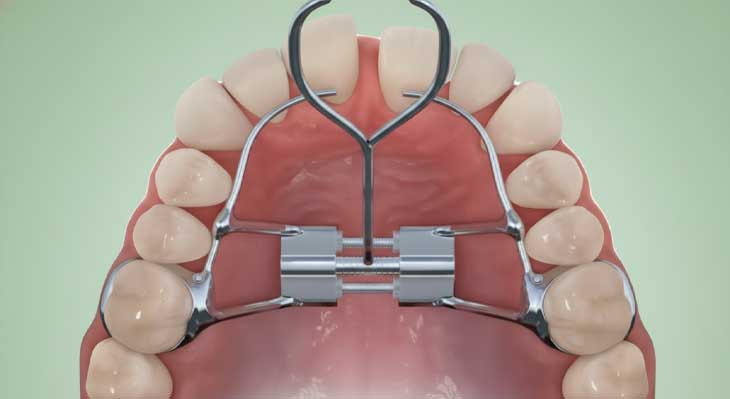 وسیع کننده کام یا پالاتال اکسپندر چیست؟