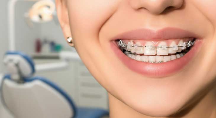 اصلاح میدلاین یا ناهماهنگی خط وسط دندان