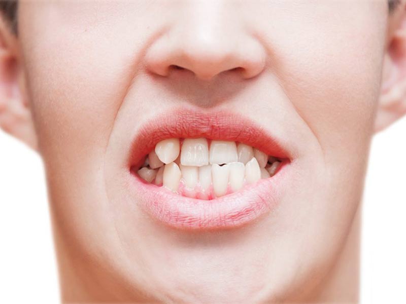 چه دندان هایی نیاز به درمان ارتودنسی دارند؟