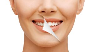 اصلاح طرح لبخند