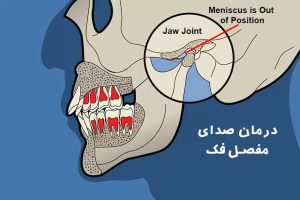 صدای مفصل فک چیست