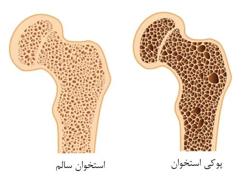 پوکی استخوان و ارتودنسی