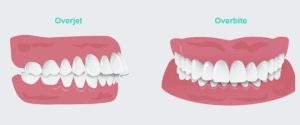 Overjet vs Overbite