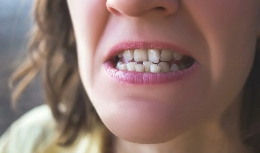 چگونه دندان های کج را بدون بریس صاف کنیم؟