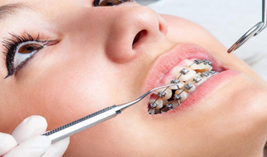 مشکلات رایج ارتودنسی