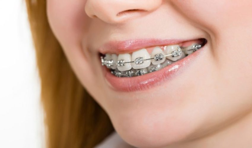 ارتودنسی فلزی بهتر است یا نامرئی؟
