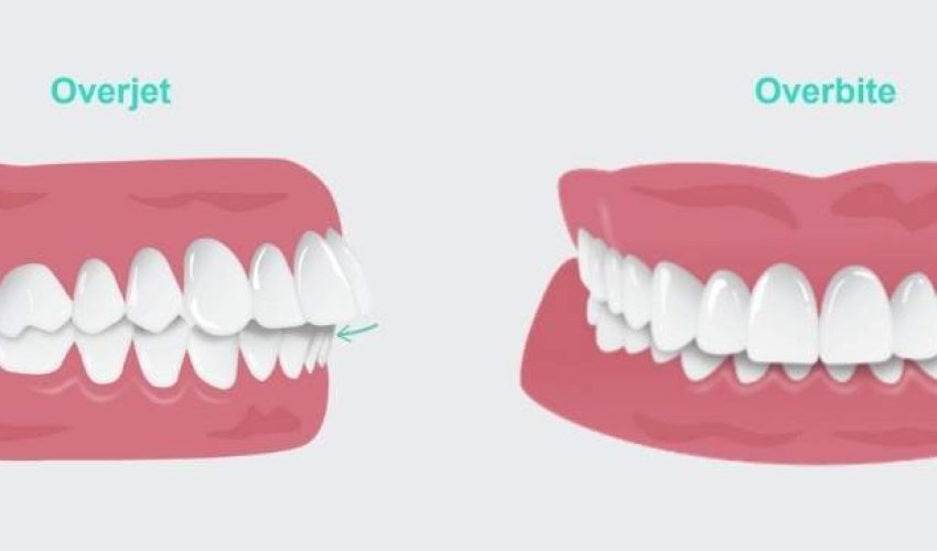 Overjet vs Overbite