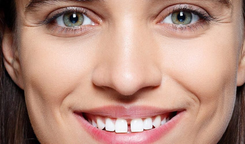 فاصله بین دندانی یا دیاستما