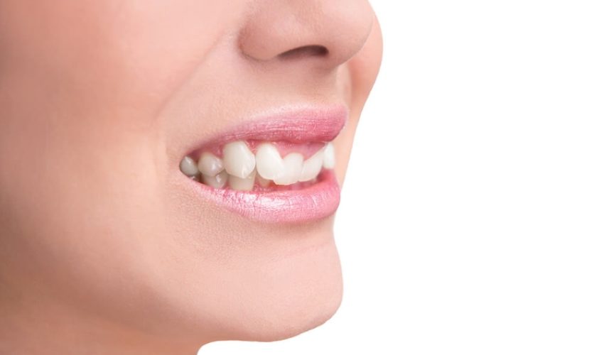 overbite