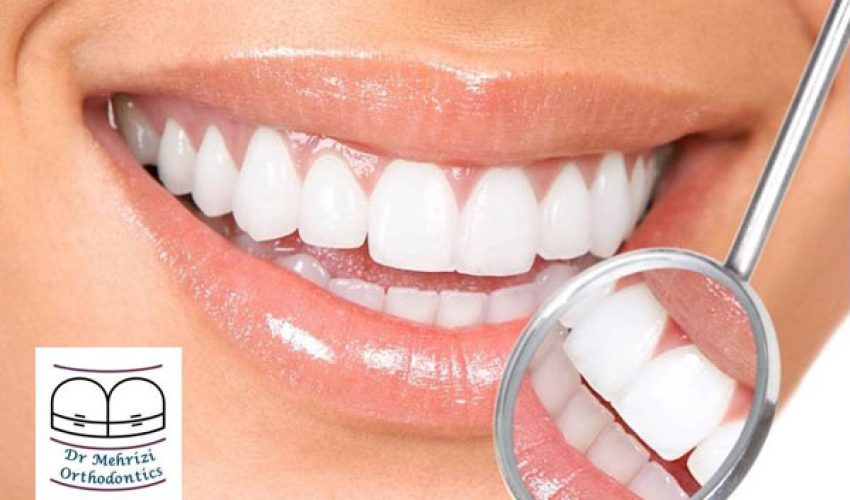 دوره نگهداری ارتودنسی ثابت