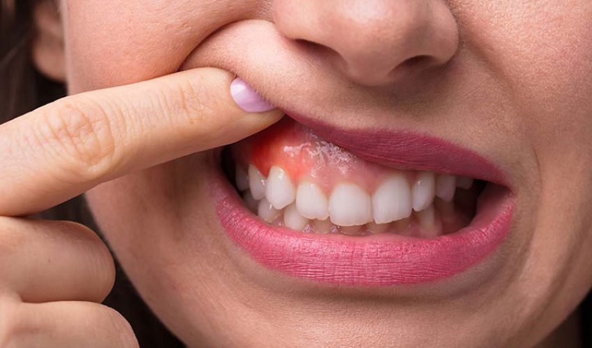روش های درمان تحلیل لثه