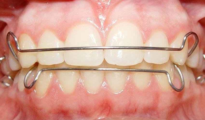 مراقبت های ارتودنسی متحرک