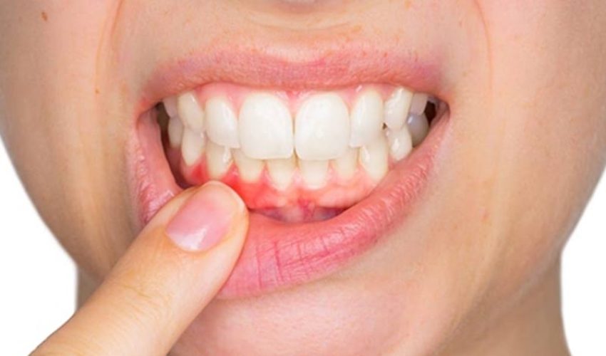 تحلیل لثه چیست؟