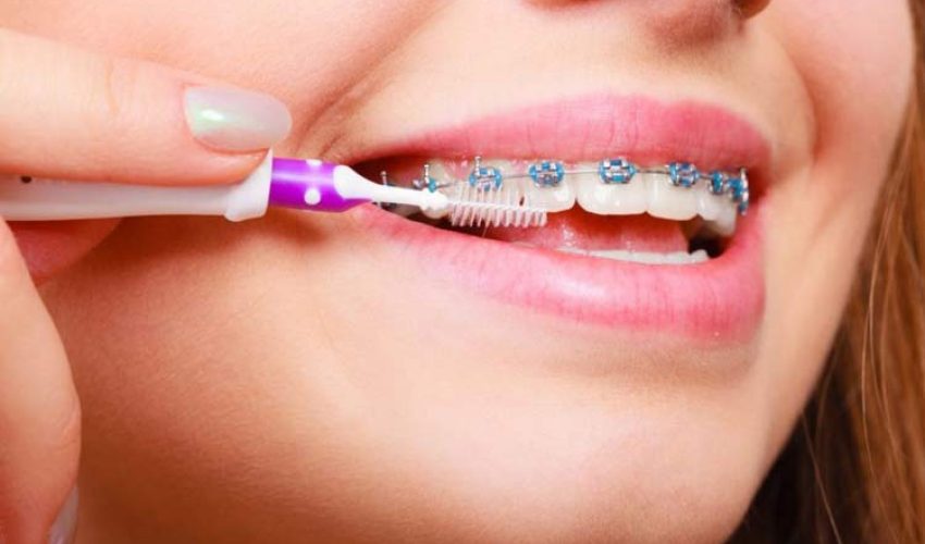 مراقبت از بریس ارتودنسی