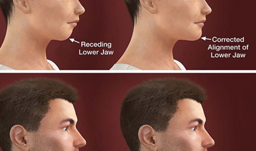 جراحی فک ارتوگناتیک