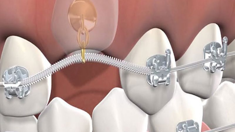 درمان دندان نیش نهفته با ارتودنسی
