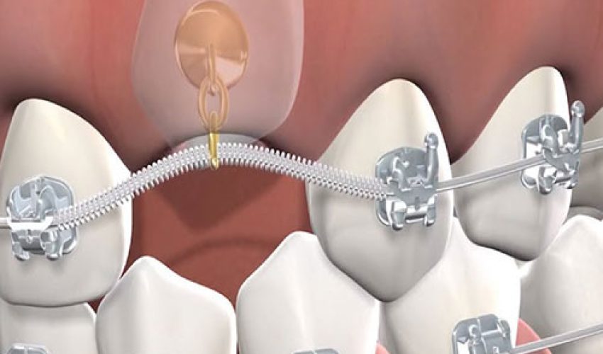 درمان دندان نیش نهفته با ارتودنسی