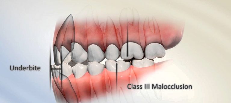 underbite malocclusion