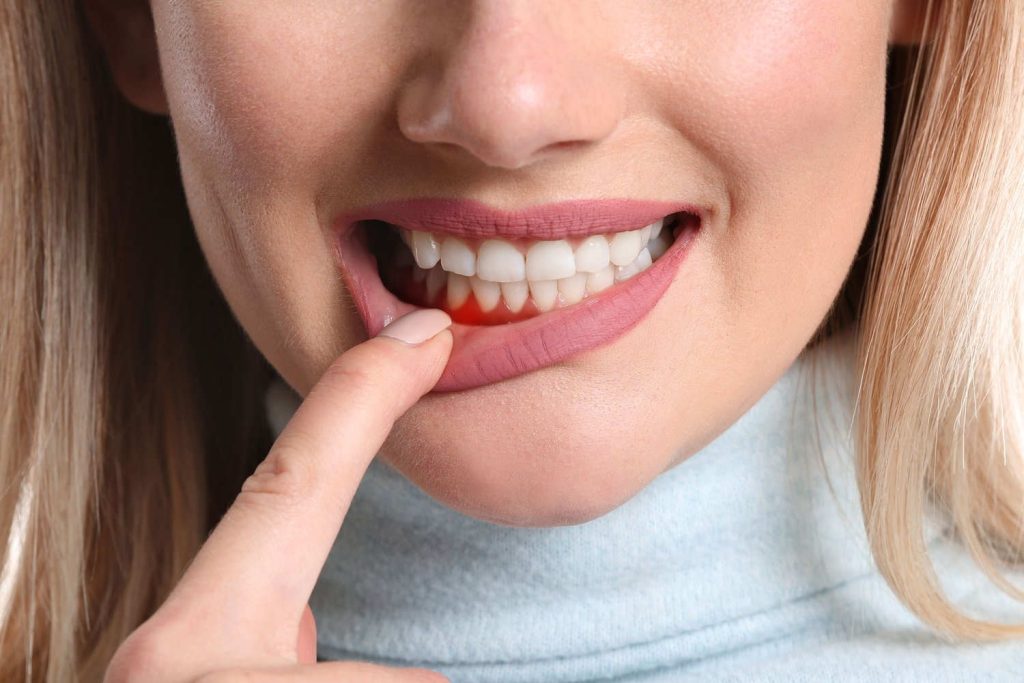 بیماری پریودنتال لثه چیست؟