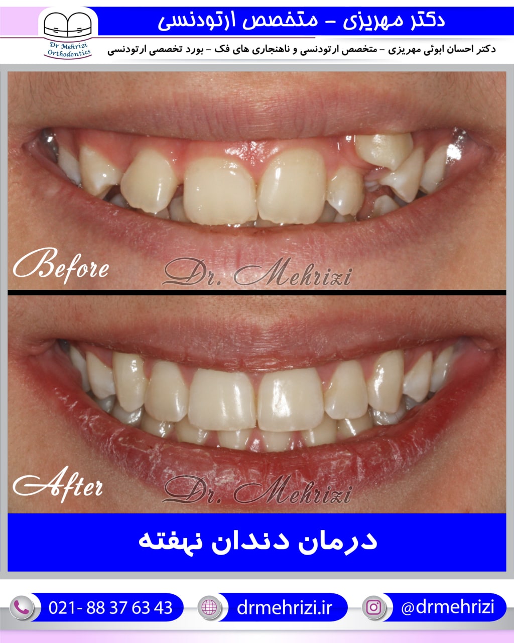 درمان ارتودنسی دندان نهفته