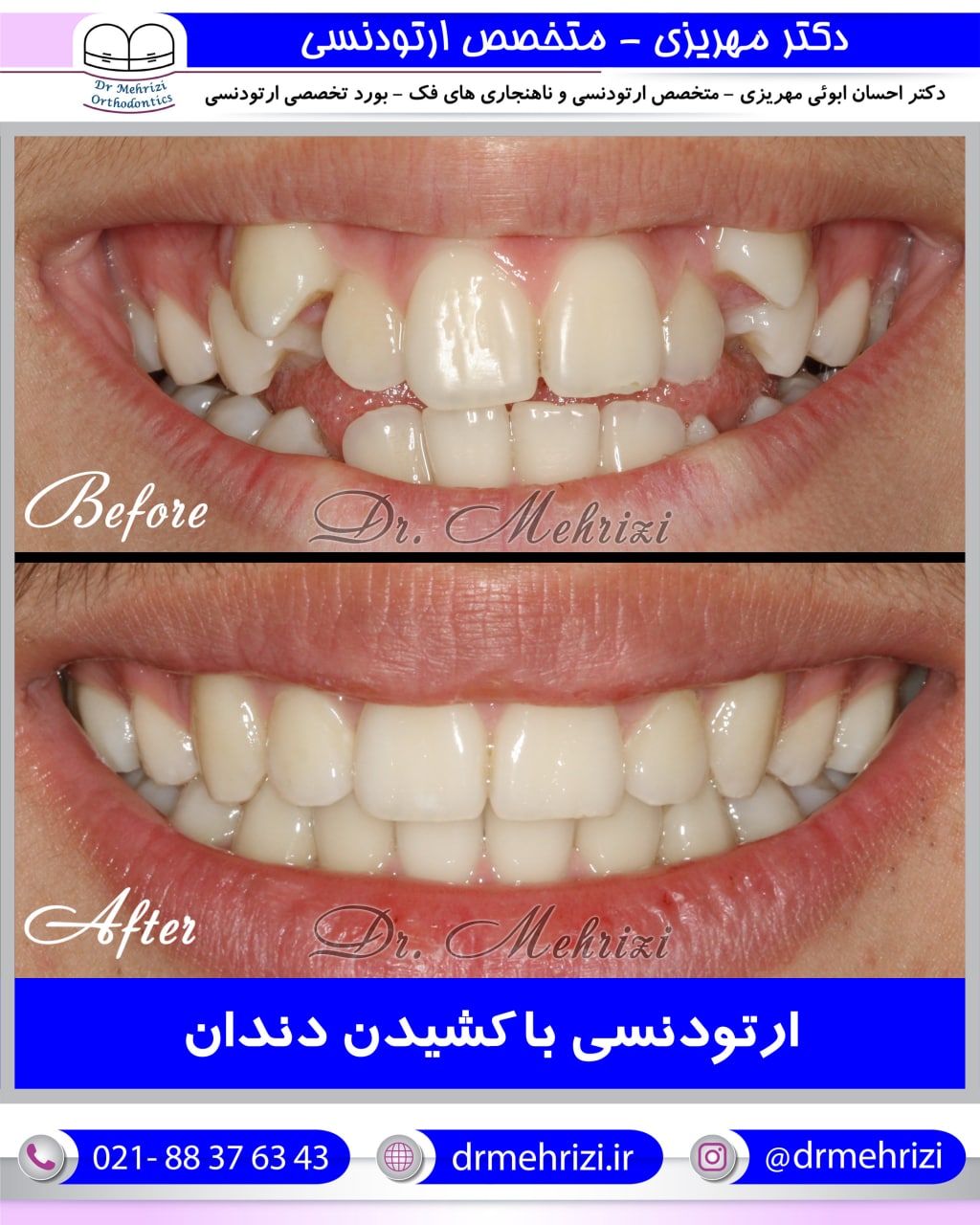 ارتودنسی با کشیدن دندان