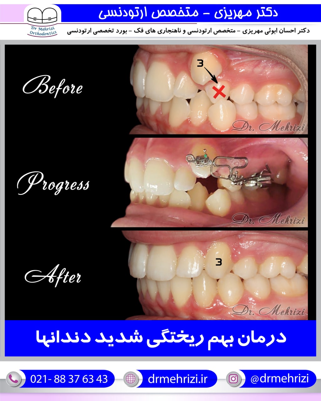 درمان بهم ریختگی شدید دندانها