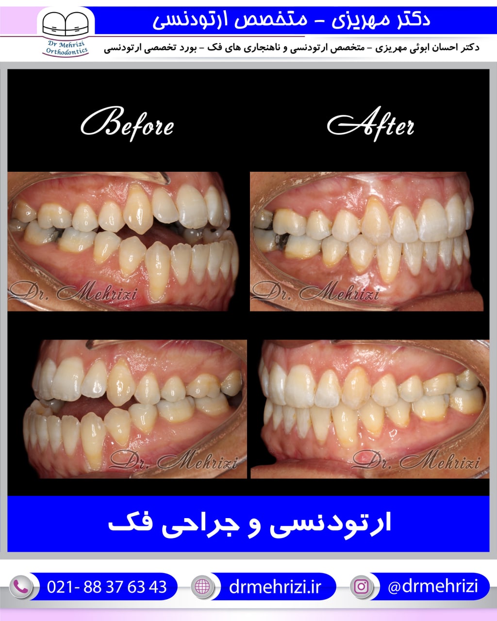 درمان ارتودنسی با جراحی فک