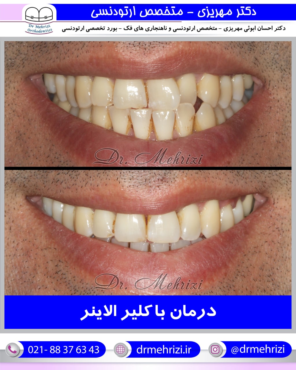 درمان ارتودنسی با کلیر الاینر