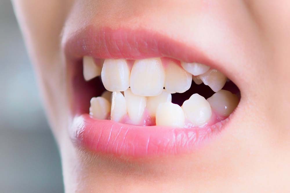 چگونه دندان های کج را بدون بریس صاف کنیم؟
